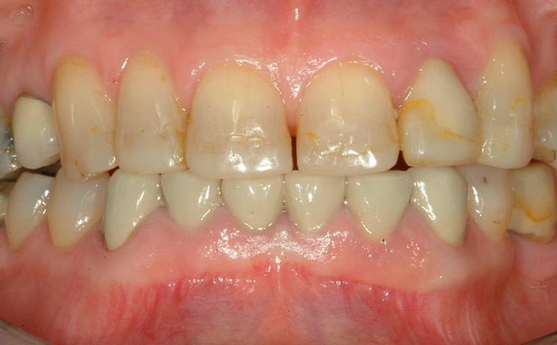 Les dents avant les soins dentaires