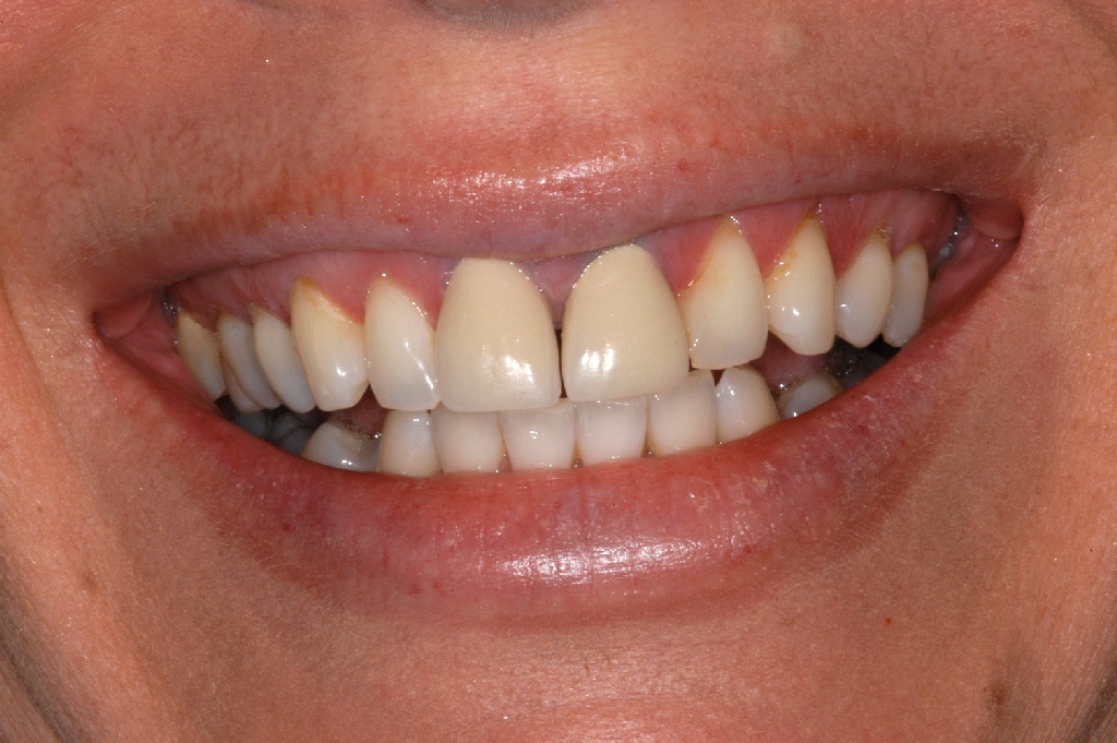 Les dents en haut avant les soins dentaires
