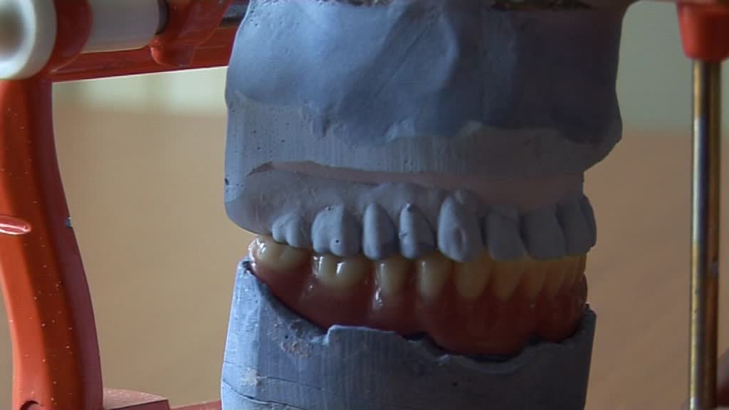 Dentier complet en résin sur la machoire inférieure
