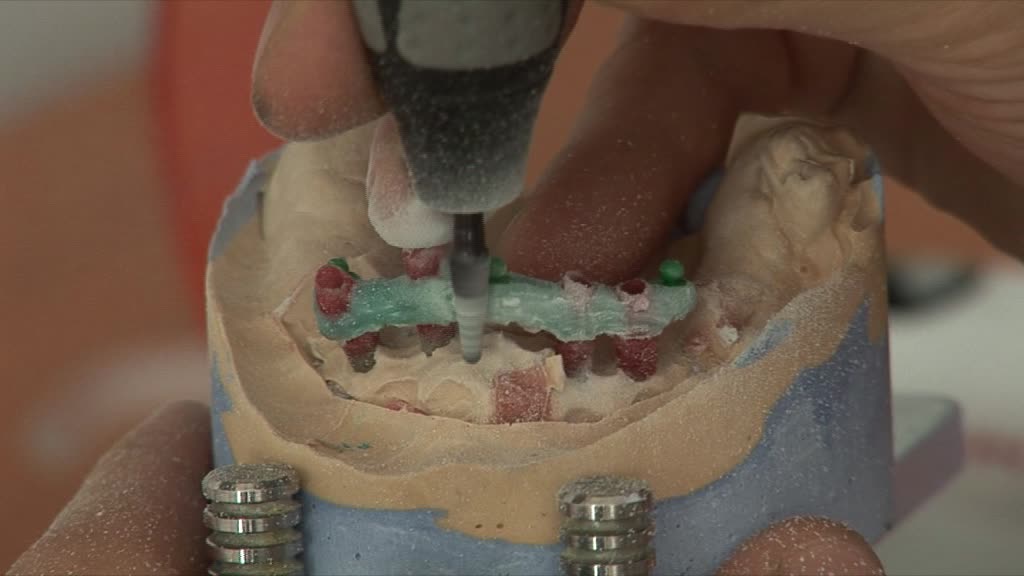 La préparation du dentier sur implants