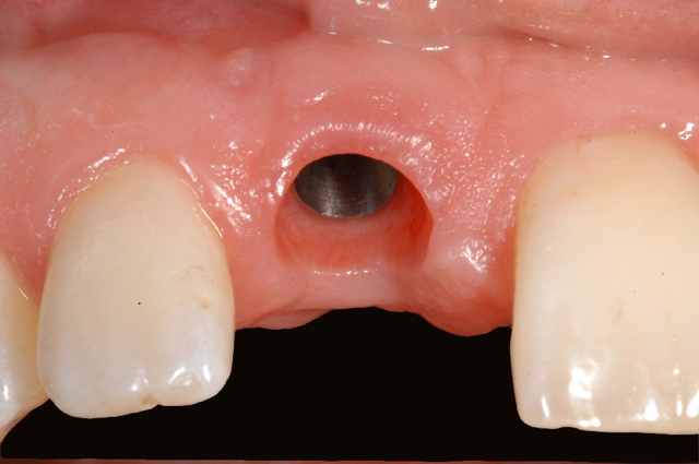 Les implants dentaires sont des racines artificielles dans l'os de la machoire. 