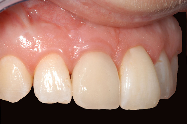 La bouche avec une couronne céramo-métallique sur un implant dentaire