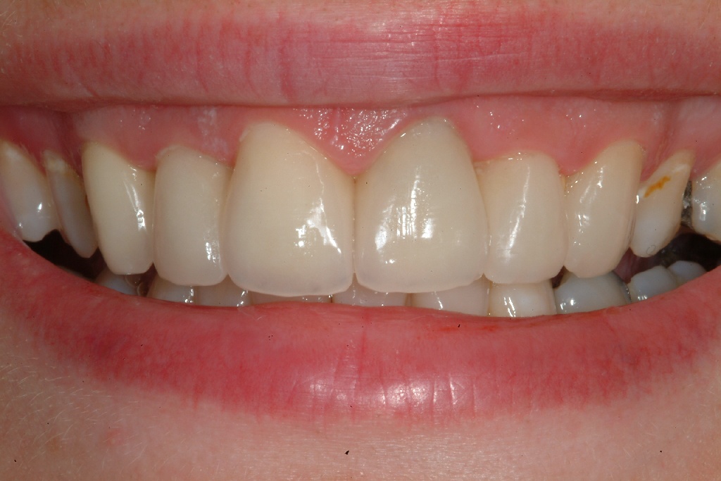 Couronne dentaire - Zircone, Céramique, Métal-céramique