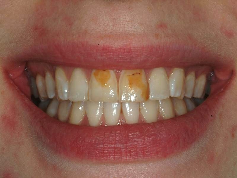 отбеливание девитальных зубов с измененным цветом
